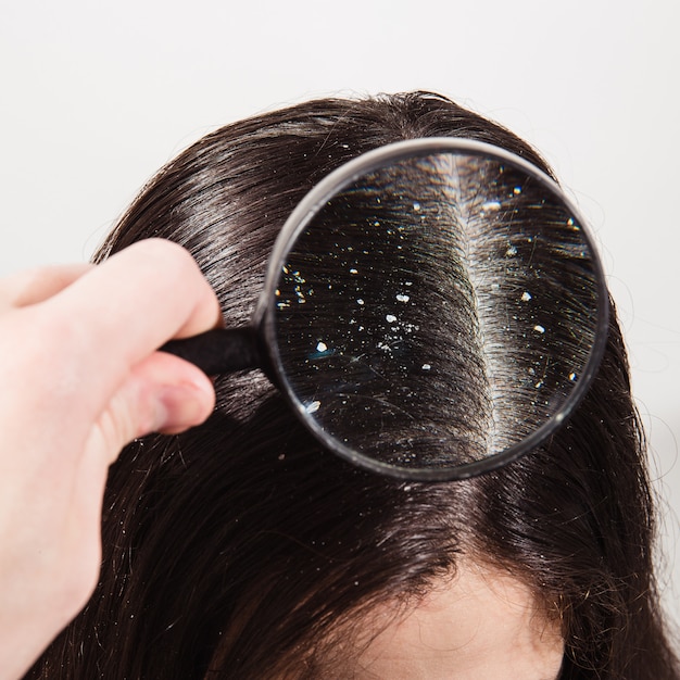 Lekarz patrzy przez szkło powiększające na łupież na ciemnych włosach kobiety