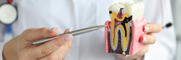 Lekarz pokazujący ubytek próchnicowy z długopisem na zbliżeniu plastikowego sztucznego zęba