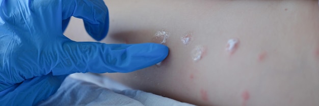 Zdjęcie lekarz w rękawiczkach nakłada krem na skórę dziecka po koszeniu owadów