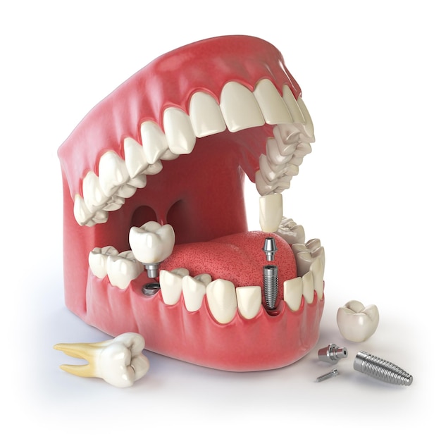 Ludzki implant zęba Koncepcja dentystyczna Ludzkie zęby lub protezy