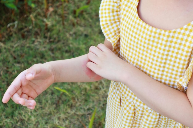 Mała dziewczynka ma alergię na wysypkę skórną i swędzenie na ramieniu