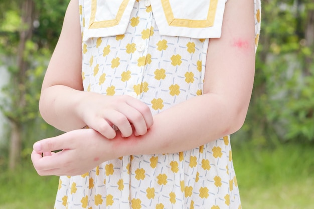 Zdjęcie mała dziewczynka ma wysypkę skórną, swędzenie i drapanie na ramieniu