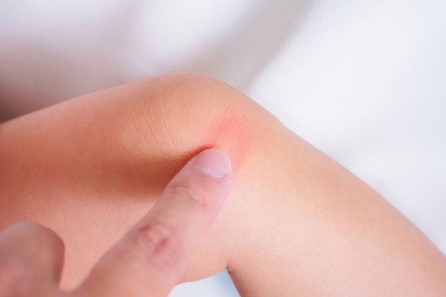 Matka nakłada krem antyalergiczny na kolano dziecka z wysypką skórną i alergią z czerwoną plamką spowodowaną ukąszeniem komara