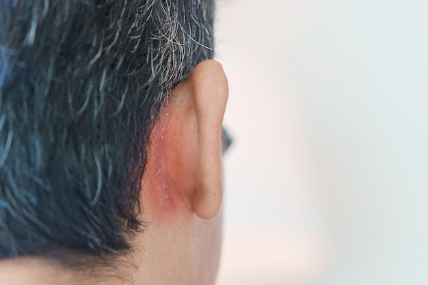 Mężczyzna mający problemy z uszami z powodu łojotokowego zapalenia skóry, łuszczycy, grzybicy i zakażenia grzybiczego skóry