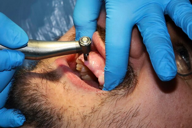 Zdjęcie mężczyzna z lekką brodą poddawany procedurze stomatologicznej