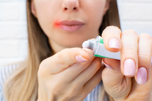 Młoda kobieta z opryszczką na ustach nakłada krem leczniczy z tubki na zbliżenie palca Pojęcie gorączki wirusowej opryszczki i zapalenia
