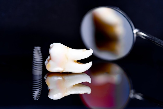 Model implantu dentystycznego na czarnym tle i lusterko dentystyczne
