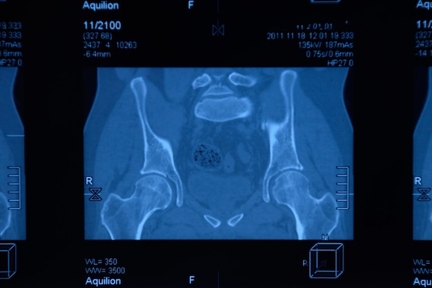 Zdjęcie mri artikulacji sakroiliackiej badanie pacjenta z zapaleniem stawów kręgosłupa