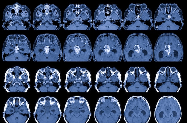 MRI Mózg z i bez środka kontrastowego Wyniki Istnieje guzek płatkowy o średnicy 35 cm