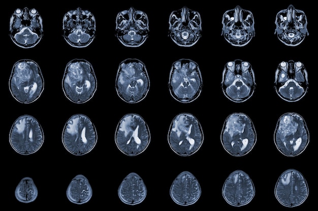 MRI Projekcja osiowa mózgu w celu oceny guza mózgu Glioblastoma przerzuty do mózgu Masa izodensyjna z niedokładnie zdefiniowanym marginesem i otaczającym obrzękiem w prawym płacie czołowym