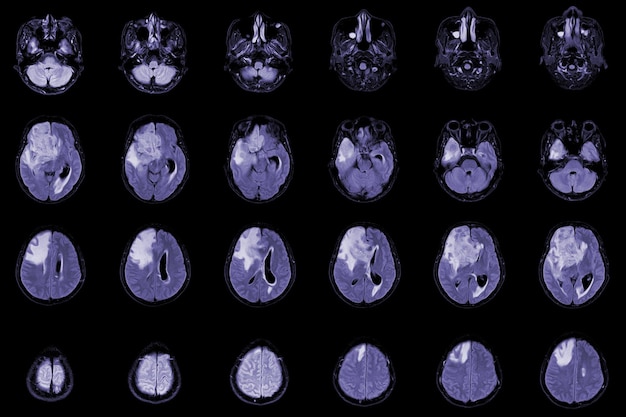 MRI Projekcja osiowa mózgu w celu oceny guza mózgu Glioblastoma przerzuty do mózgu Masa izodensyjna z niedokładnie zdefiniowanym marginesem i otaczającym obrzękiem w prawym płacie czołowym