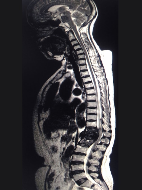 MRI Spine złamał złamanie T12.