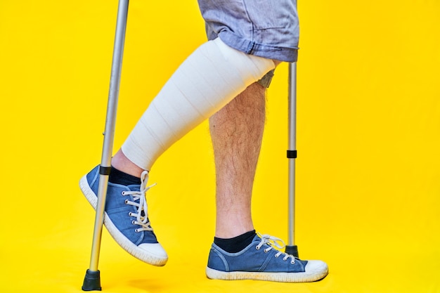 Zdjęcie na rysunku w zbliżeniu przedstawiono nogi mężczyzny o prawym profilu, w szortach, o kulach, z zabandażowaną nogą.