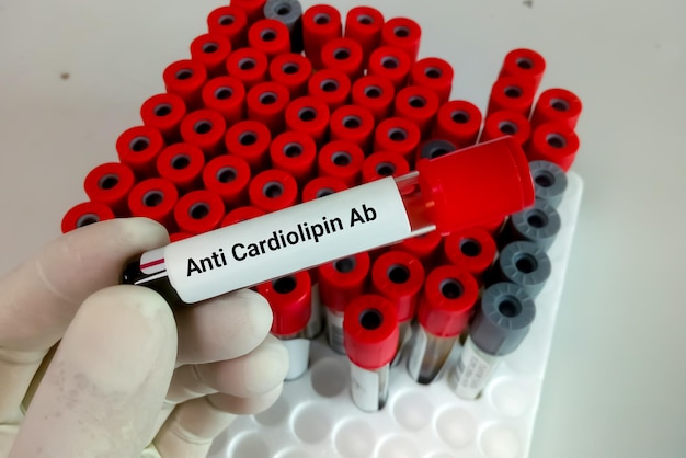 Naukowiec przechowuje próbkę krwi do testu antykardiolipinowego Ab