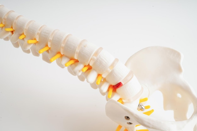 Nerw Kręgosłupowy I Kość Kręgowca Lędźwiowego Przemieszczony Pęknięty Fragment Dysku Model Leczenia Medycznego
