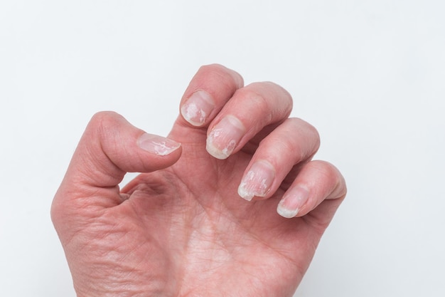 Obgryzione i złamane paznokcie bez manicure z przerośniętym naskórkiem i uszkodzoną płytką paznokcia po nałożeniu lakieru hybrydowego
