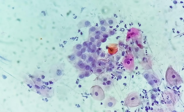 Zdjęcie obraz mikroskopiczny trichomonas vaginalis w wymazie pap z komórkami ostrego zapalenia
