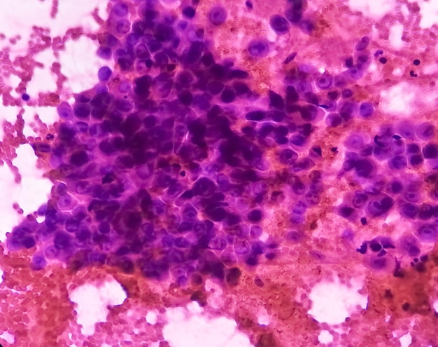 Obraz mikroskopowy FNAC pod kontrolą TK z rakiem śluzówkowo-naskórkowym