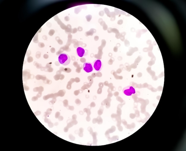Obraz mikroskopowy trombocytopenii lub małej liczby płytek krwi