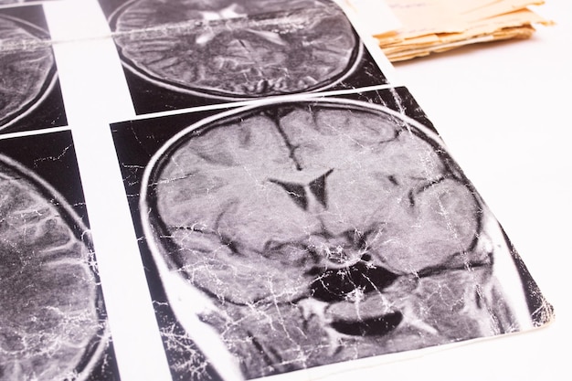 Obraz MRI mózgu na papierze
