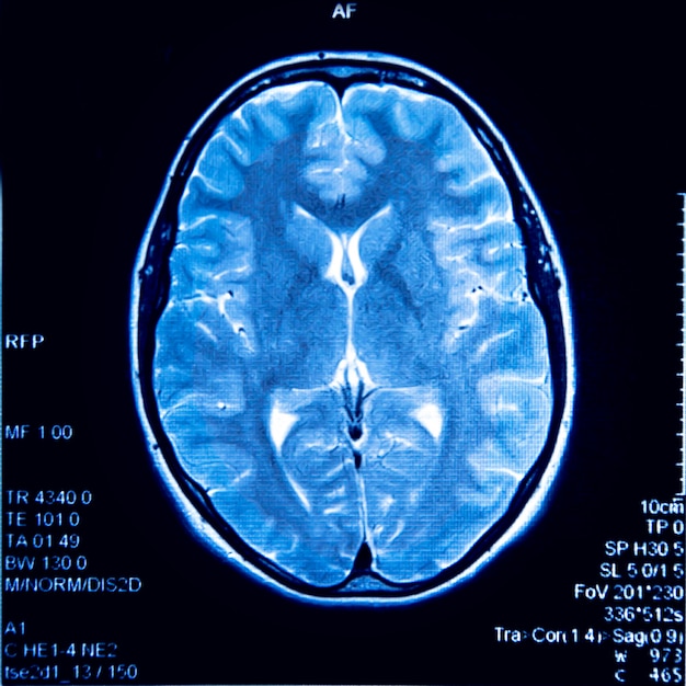Obraz MRI mózgu