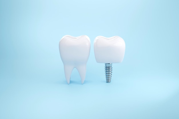 Oczyść zdrowe zęby za pomocą implantu dentystycznego