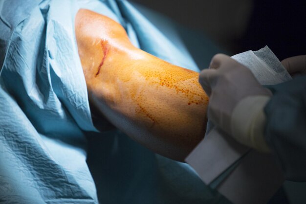 Zdjęcie odcięta ręka chirurga operującego pacjenta w szpitalu