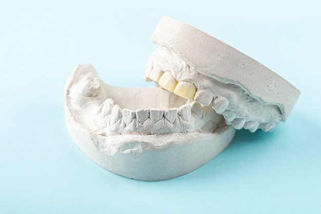 Odlewy Gipsowe Stomatologiczne, Formy Ludzkich Szczęk I Zębów. Gips Odlewniczy Do Produkcji Protez Dentystycznych, Aparatów Ortodontycznych Lub Sztucznych Zębów. Koncepcja Stomatologii I Ortodoncji.