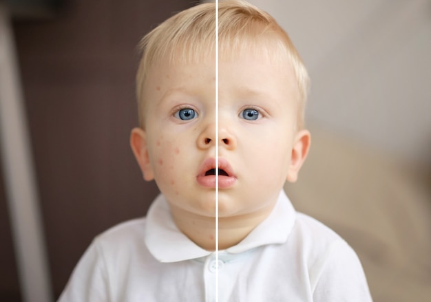 ospa wietrzna dziecko, ospa, ugryzienie komara, reakcja alergiczna, przed i po wyzdrowieniu