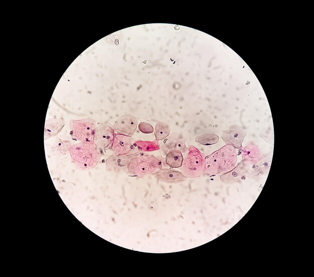 Zdjęcie pap smear zapalny smear z zmianami związanymi z hpv rak szyjki macicy scc