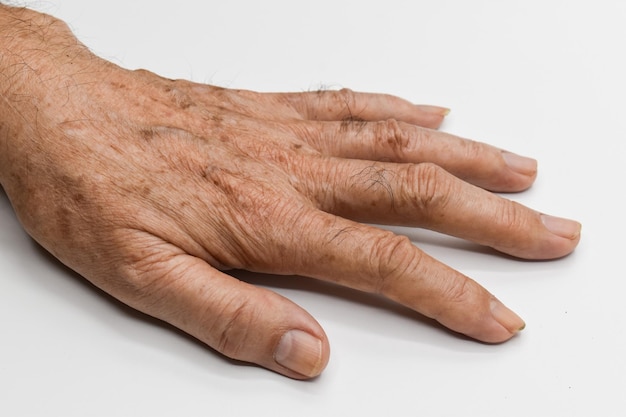 Plamy starcze na dłoni starszego mężczyzny z Azji Są to brązowoszare lub czarne plamy zwane plamami wątrobowymi lub słonecznymi