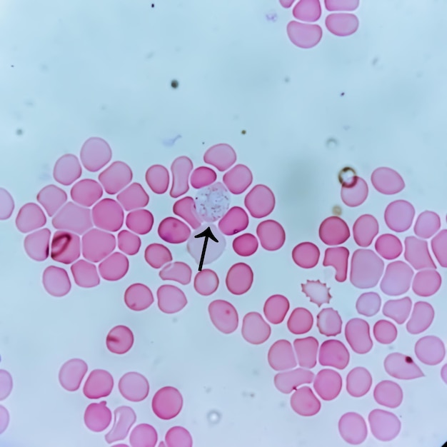 Zdjęcie plasmodium vivax w cienkiej folii pod mikroskopem choroba malaryjna p vivax pasożyt malaryczny