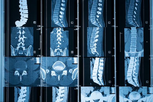 Płaszczyzna kręgosłupa do obrazowania metodą rezonansu magnetycznego (MRI)
