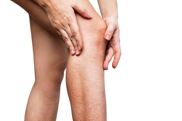 Podrażnienie i zaczerwienienie skóry wrażliwej po depilacji. Młoda kobieta dotyka ręką swojej nogi