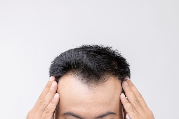 Portret Azjatyckiego Mężczyzny Ze Zmartwieniem I Dotykaniem Głowy, Aby Pokazać łysą Głowę Lub Nagi Problem. Studio Strzelać Z Miejsca Na Kopię Z Szarą ścianą