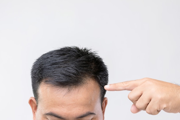 Portret Azjatyckiego Mężczyzny Ze Zmartwieniem I Dotykaniem Głowy, Aby Pokazać łysą Głowę Lub Nagi Problem