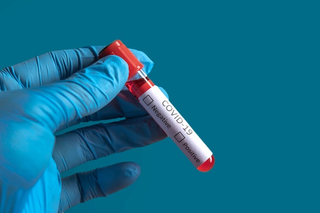 Pozytywna Próbka Krwi Z Wirusem Covid-19 Lub Nowym Koronawirusem 2019 Znalezionym W Wuhan W Chinach