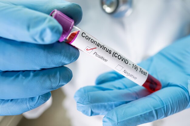 Pozytywna próbka zakażenia krwi w probówce na koronawirusa Covid19 w laboratorium