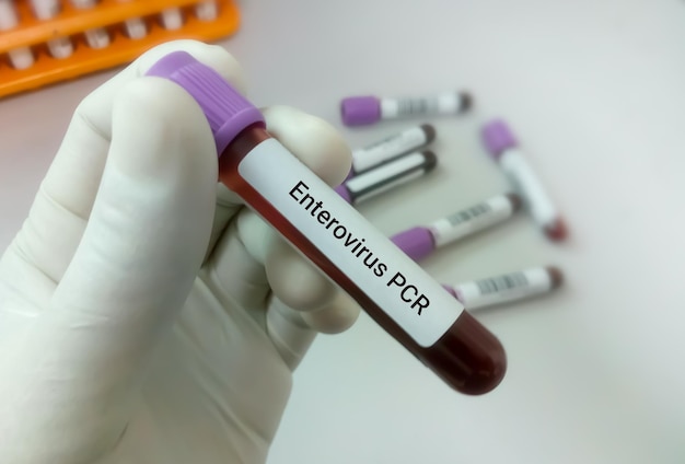 Próbka krwi do badania Enterovirus PCR