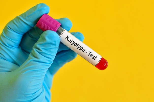 Próbka krwi do badania karyotypu nieprawidłowych chromosomów