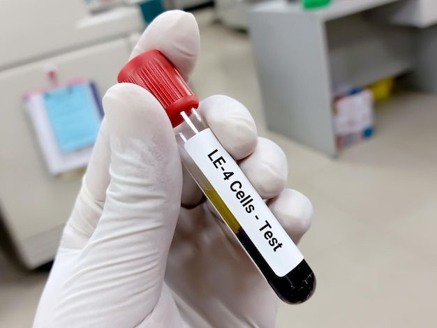 Próbka Krwi Do Badania Komórek Le4 Toczeń Rumieniowaty Koncepcja Badań Medycznych