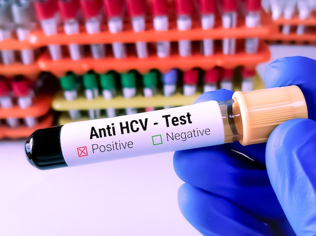 Zdjęcie próbka krwi do testu anty hcv test na przeciwciała hcv wirus zapalenia wątroby typu c