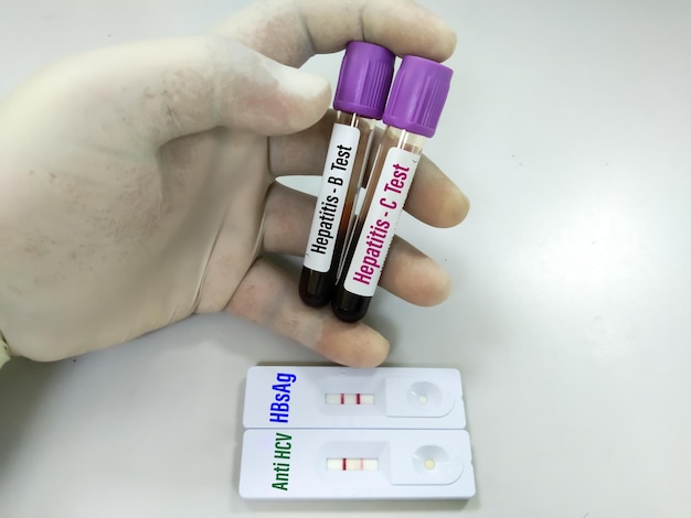 Próbka krwi do testu na wirusowe zapalenie wątroby typu A, B i C z zestawem do szybkiego testu. Wynik pozytywny. test wątrobowy