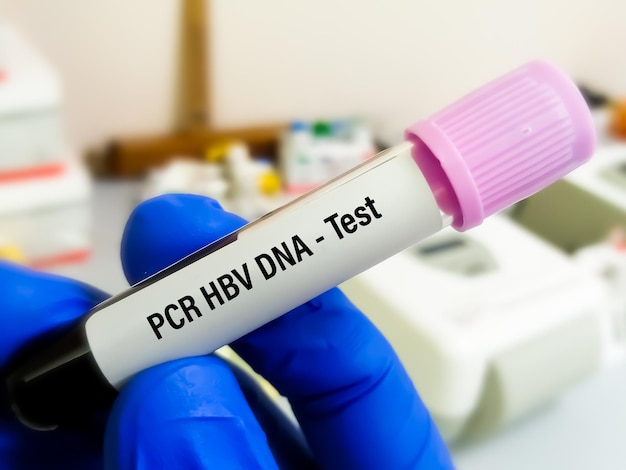 Zdjęcie próbka krwi do testu pcr hbv dna (jakościowe i ilościowe), koncepcja opieki zdrowotnej lub medycznej.