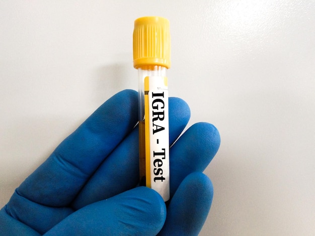 Próbka krwi do testu T SPOT (TB) i IGRA (test uwalniania interferonu gamma) do diagnozy MTB.