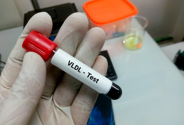 Zdjęcie próbka krwi do vldl lub testu lipoprotein o bardzo niskiej gęstości lub bardzo złego cholesterolu