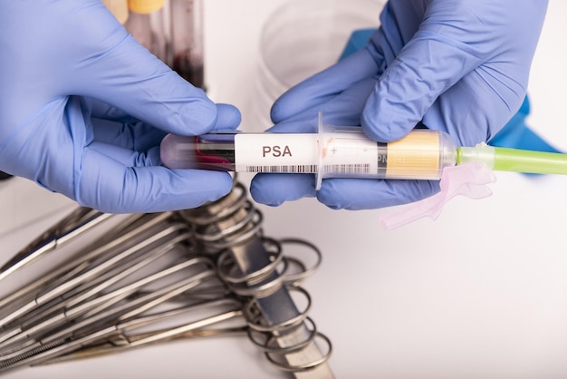 Próbka krwi z nieprawidłowo wysokim wynikiem testu PSA