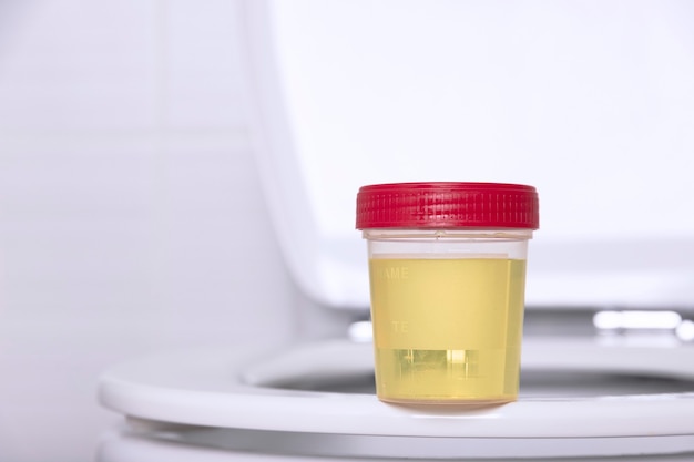 Zdjęcie próbka moczu w pojemniku medycznym znajduje się na brzegu białej toalety domowej