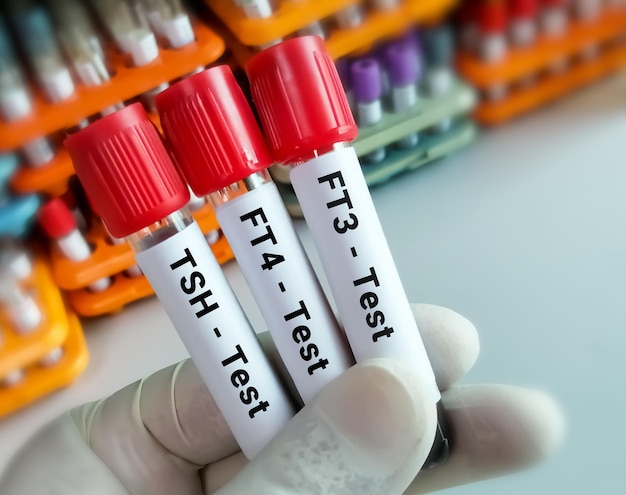 Próbki krwi do badania hormonalnego tarczycy w laboratorium lub test FT3 FT4 TSH