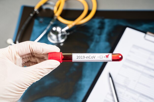 Probówka Z Krwią W Ręce Lekarza, Etykieta Testowa Koronawirusa Mers-cov W Szpitalnej Probówce Do Analizy Infekcja Wirusowa 2019-ncov Pochodząca Z Wuhan W Chinach